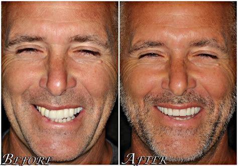 All On 4 Dental Implants Before And After All On 4 Dental Implants Before And After