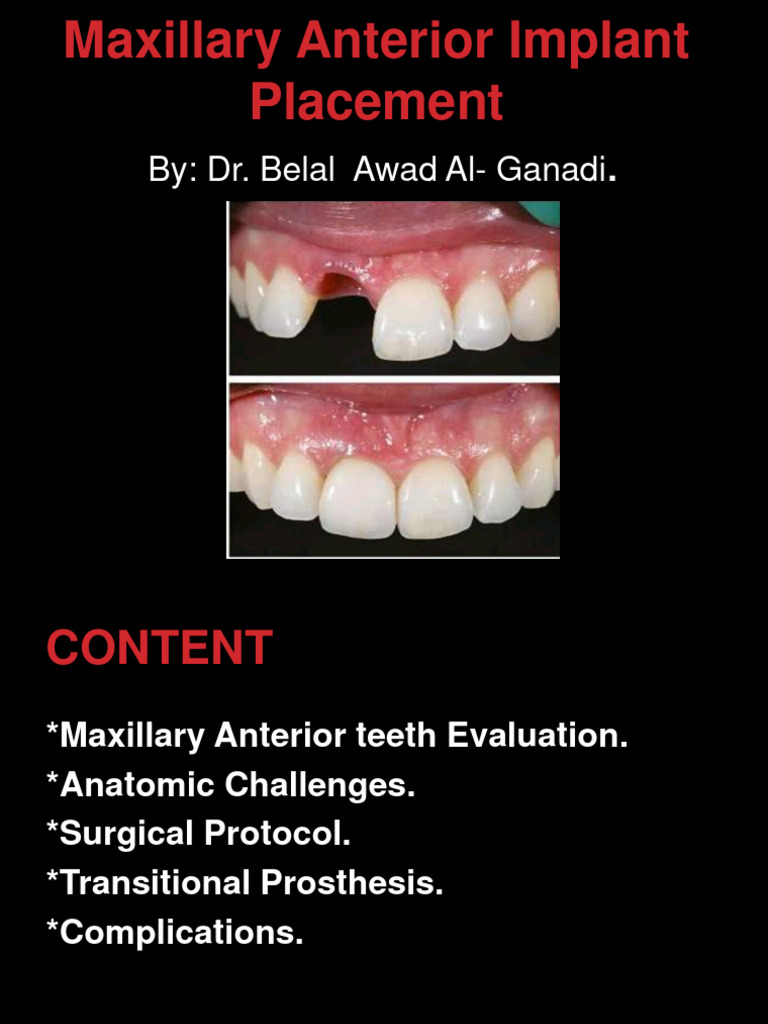 Anterior Implant Rehabilitation Setting The Foundation Page 1 Of 0 Anterior Implant Rehabilitation Setting The Foundation Page 1 Of 0