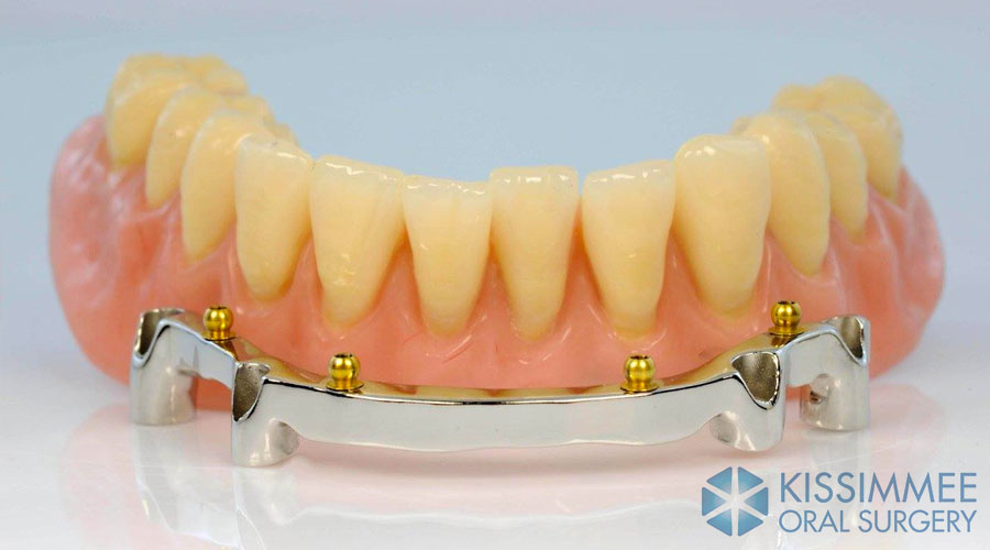 Bar Attachment Denture Minneapolis Oral Surgeons Minnesota Oral Bar Attachment Denture Minneapolis Oral Surgeons Minnesota Oral