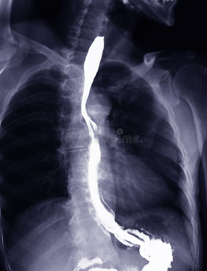 Barium Swallow Study Test Diagnose Barrett S Gi Tract Exam Gerd Ulcers Barium Swallow Study Test Diagnose Barrett S Gi Tract Exam Gerd Ulcers