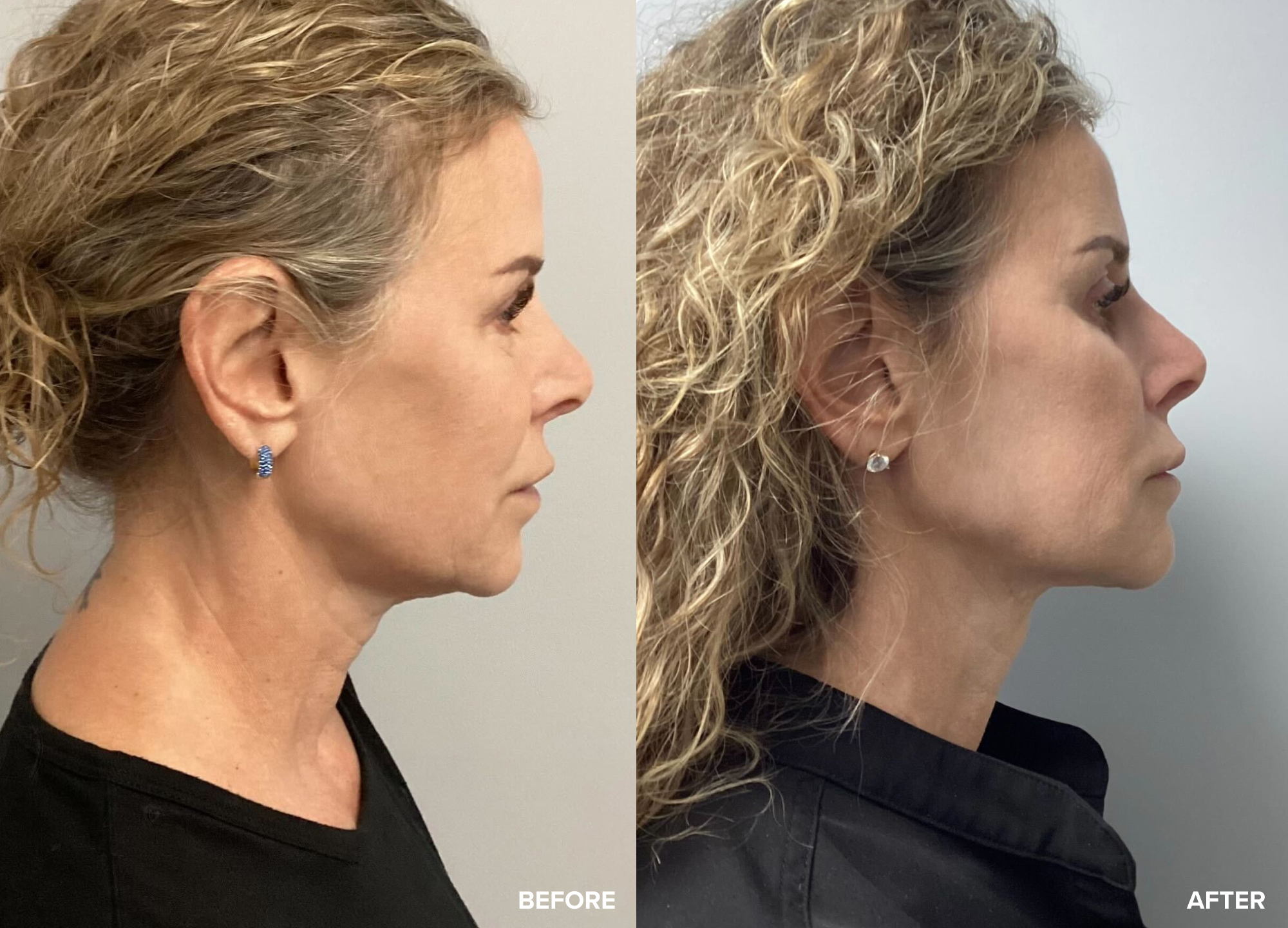 Before After Photos Before After Photos