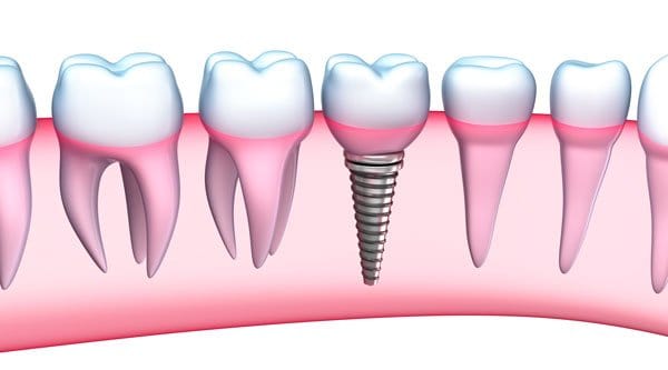 Biocompatible Dentistry Faqs Dr Maddahi Biocompatible Dentistry Faqs Dr Maddahi
