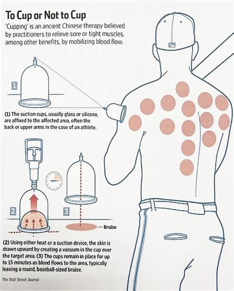 Cupping Therapy Toronto Reflexology Cupping Therapy Toronto Reflexology