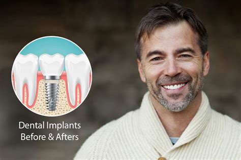 Dental Implants Beverly Hills Best Implants Dentist Beverly Hills Ca Dental Implants Beverly Hills Best Implants Dentist Beverly Hills Ca