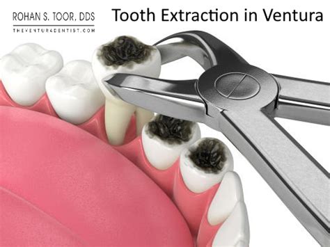 Dentist Extraction Near Me