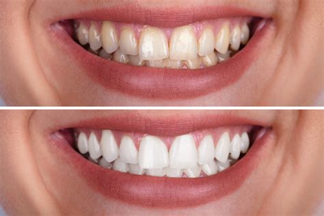 Dentist Teeth Whitening Near Me