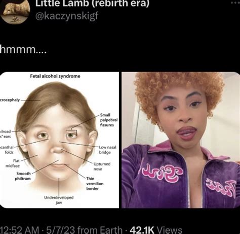 Does Ice Spice Have Albinism Unveiling The Truth Behind The Rumors Does Ice Spice Have Albinism Unveiling The Truth Behind The Rumors