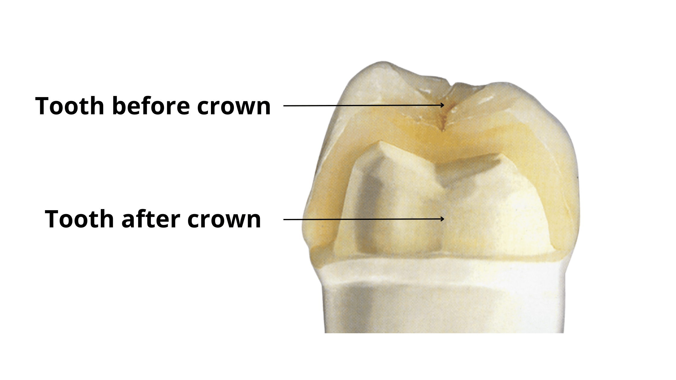 Finding Solutions For A Cracked Tooth Beneath A Crown Affordable Finding Solutions For A Cracked Tooth Beneath A Crown Affordable