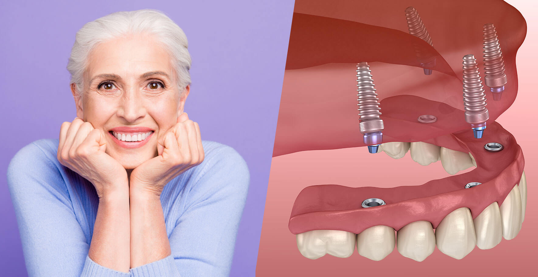 Full Mouth Dental Implants Houston Memorial Tanglewood Missing Full Mouth Dental Implants Houston Memorial Tanglewood Missing