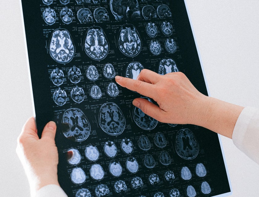 Neurology Careers: Unlocking Brain Mysteries