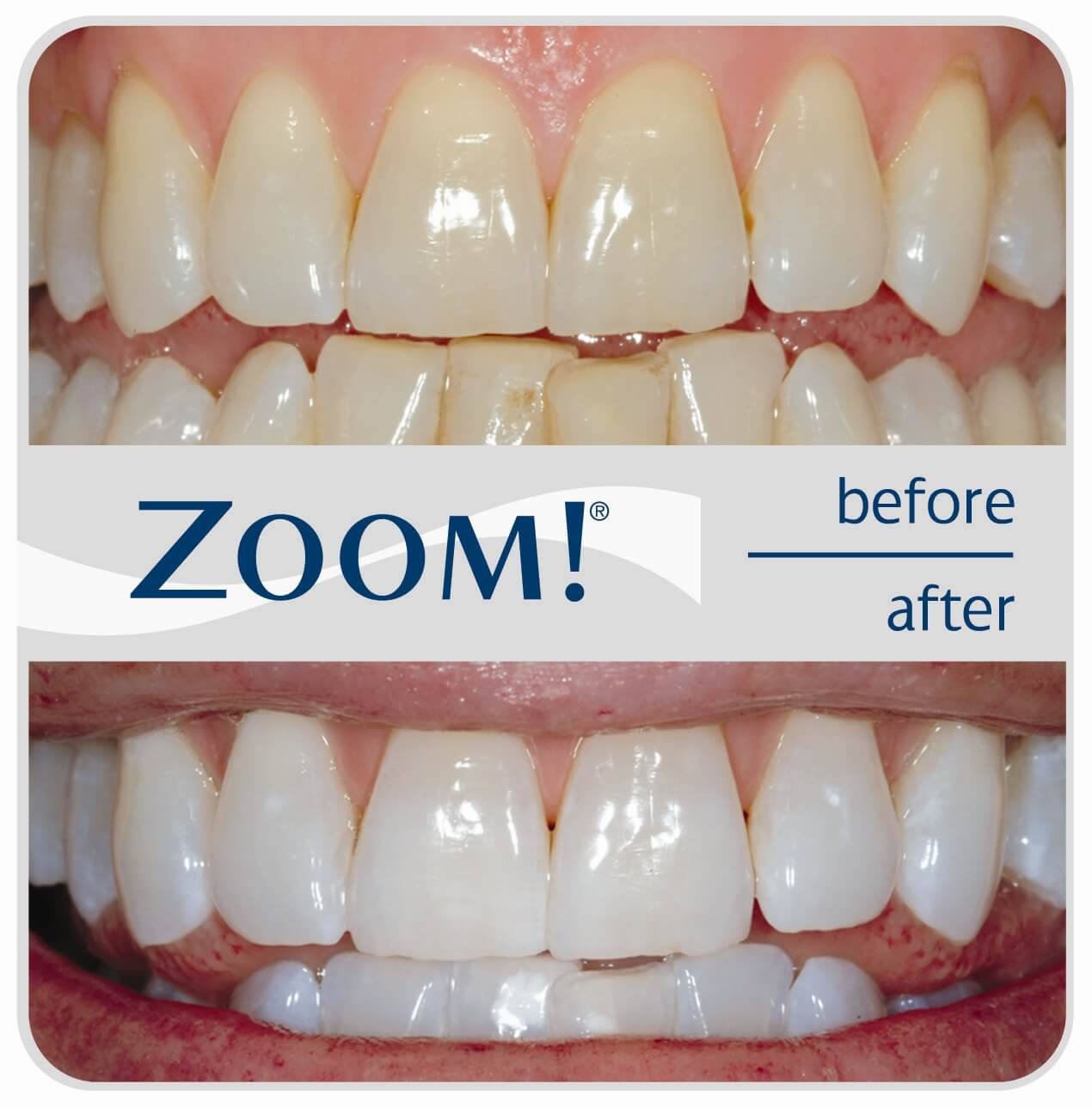 Professional Teeth Whitening Dentist Near Me Low Tone Webzine Picture Professional Teeth Whitening Dentist Near Me Low Tone Webzine Picture