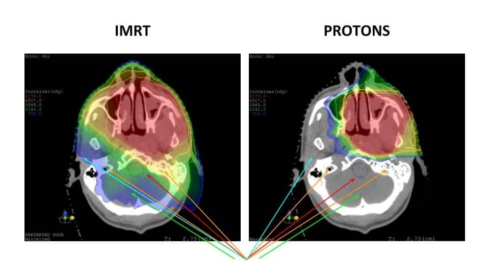Prostate Cancer Proton Therapy Oklahoma Proton Center Prostate Cancer Proton Therapy Oklahoma Proton Center
