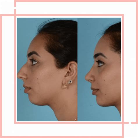 Understanding Minitinah Surgery A Comprehensive Guide Understanding Minitinah Surgery A Comprehensive Guide