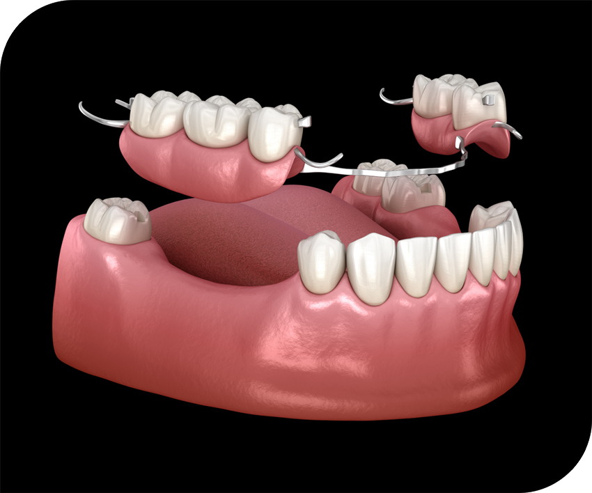 What To Know About Comfort In Removable Partial Dentures Affordable What To Know About Comfort In Removable Partial Dentures Affordable