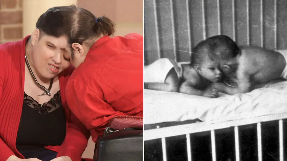 World S Oldest Conjoined Twins Lori And George Schappell Dead At 62 World S Oldest Conjoined Twins Lori And George Schappell Dead At 62